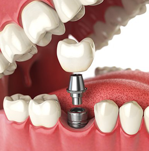 illustration of dental implant