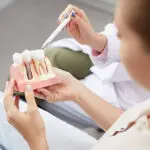 dental implants, model of dental implants at dental office, dental implants johnson city