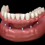 types of dentures, complete dentures, partial dentures, implant-supported dentures, immediate dentures, denture care, Blue Plum Dental, Johnson City TN dentist, dental implants, dental crowns
