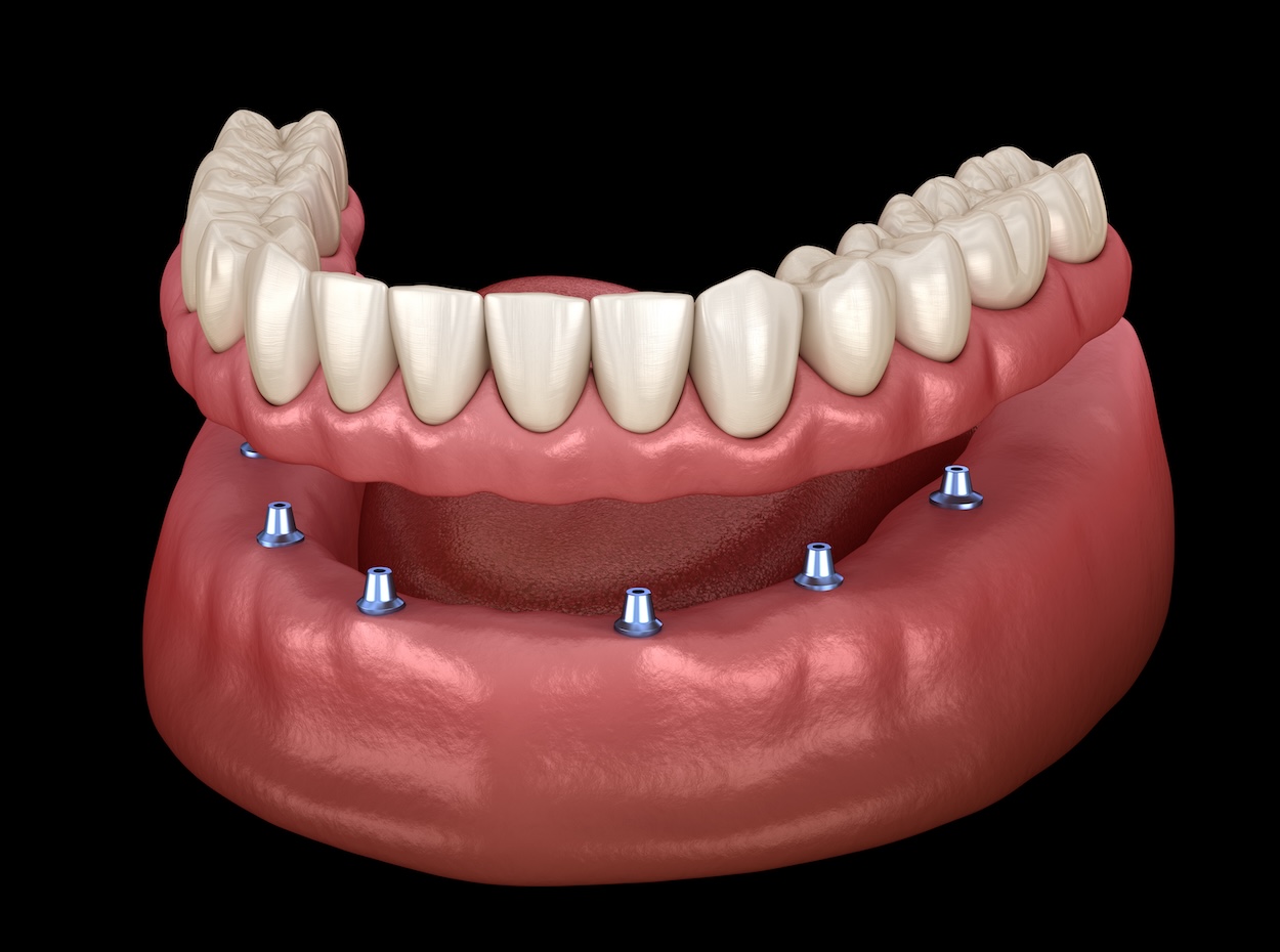 types of dentures, complete dentures, partial dentures, implant-supported dentures, immediate dentures, denture care, Blue Plum Dental, Johnson City TN dentist, dental implants, dental crowns