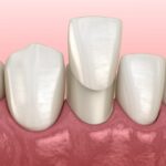 pros and cons of dental veneers, dental veneers, cosmetic dentistry, Blue Plum Dental, Johnson City TN dentist, veneers benefits, veneers drawbacks, Dr. David Miranda, Dr. Mead Lyons