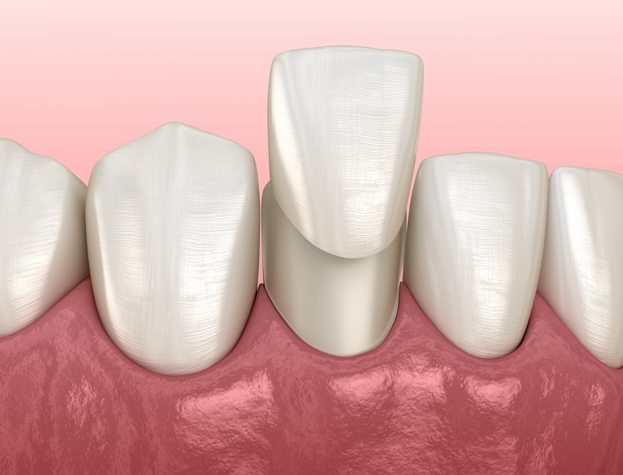 pros and cons of dental veneers, dental veneers, cosmetic dentistry, Blue Plum Dental, Johnson City TN dentist, veneers benefits, veneers drawbacks, Dr. David Miranda, Dr. Mead Lyons