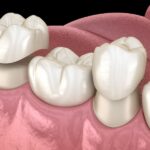 crowns, dental implants, tooth restoration, Johnson City dentist, tooth replacement, dental health, Blue Plum Dental