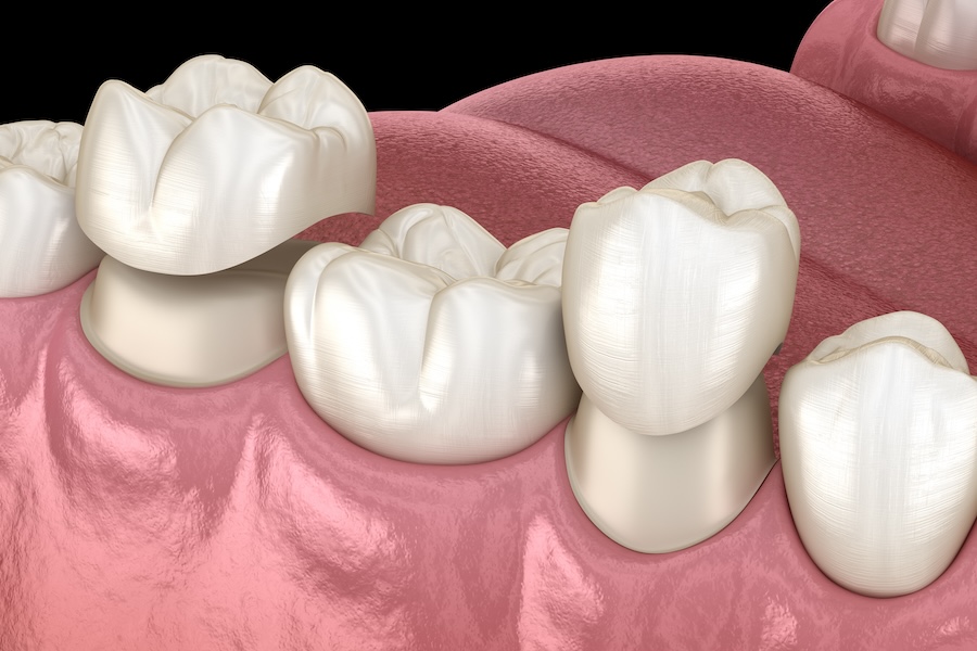 crowns, dental implants, tooth restoration, Johnson City dentist, tooth replacement, dental health, Blue Plum Dental