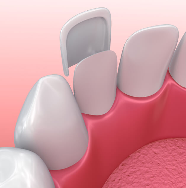 illustration of a dental veneer