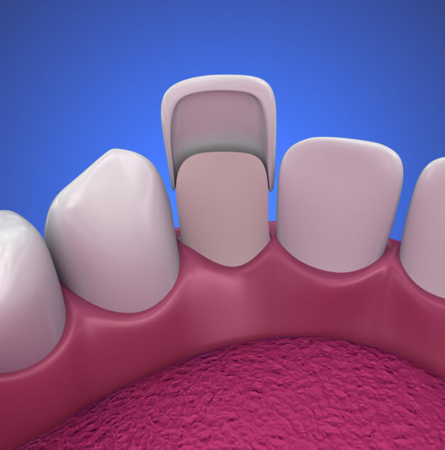 illustration of a dental veneer