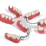 partial denture, types of partial dentures, Blue Plum Dental, Dr. David Miranda, Johnson City TN dentist