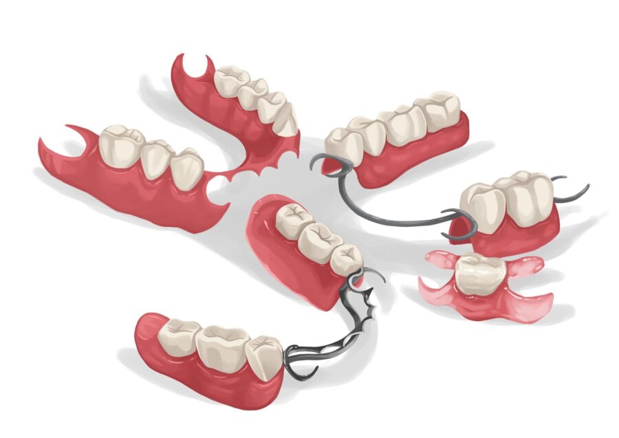 partial denture, types of partial dentures, Blue Plum Dental, Dr. David Miranda, Johnson City TN dentist