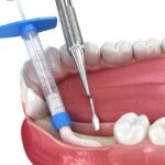 bone grafts, dental bone graft, jawbone restoration, osseointegration, Blue Plum Dental, Johnson City TN, dental implants, gum disease, tooth loss repair, bone health dentistry