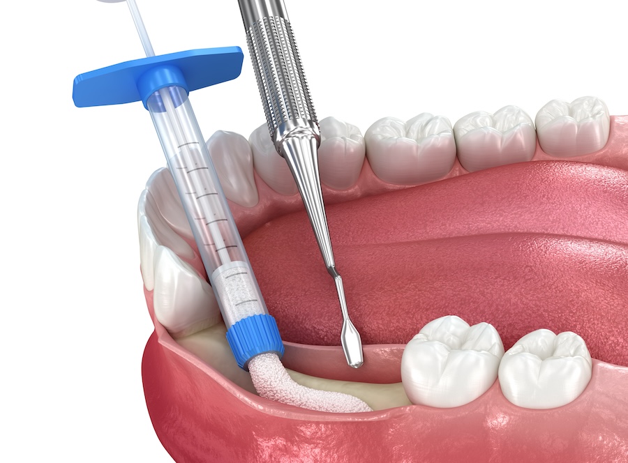 bone grafts, dental bone graft, jawbone restoration, osseointegration, Blue Plum Dental, Johnson City TN, dental implants, gum disease, tooth loss repair, bone health dentistry