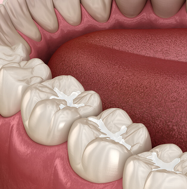illustration of composite fillings