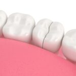 cracked tooth chipped tooth dental emergency