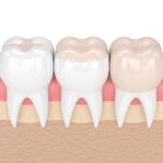 denta filling vs dental crown