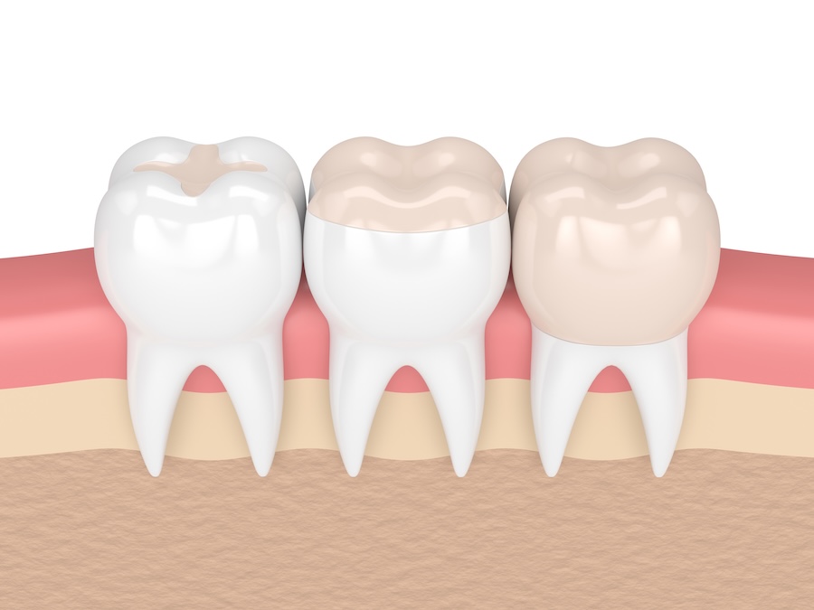 denta filling vs dental crown