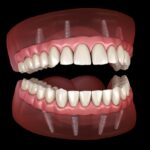 All on 4 Implant supported dentures