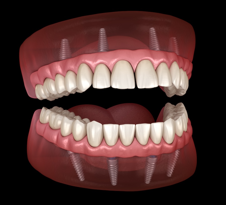 All on 4 Implant supported dentures