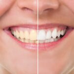 teeth whitening tooth sensitivity