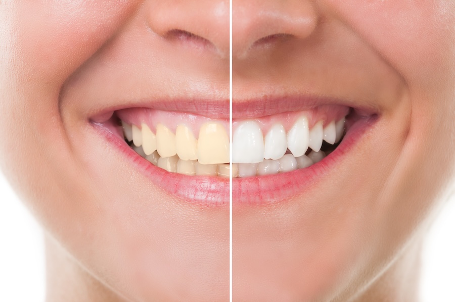 teeth whitening tooth sensitivity